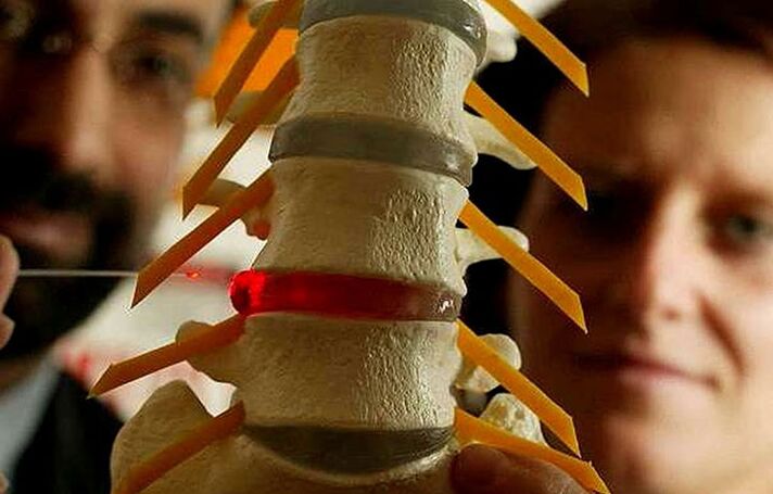 Cambios en la integridad de los registros intervertebrales