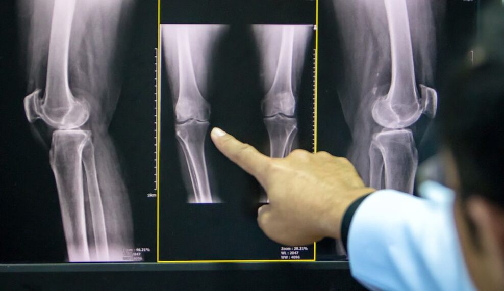 artrosis de rayos x de rodilla