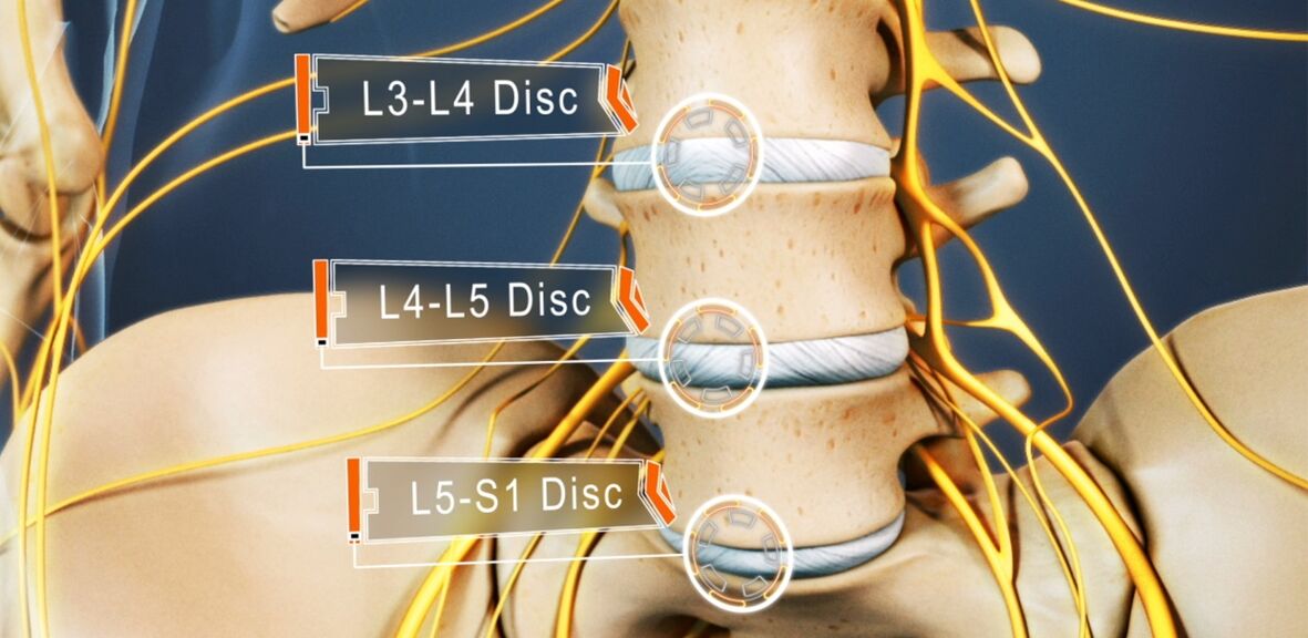 Discos de la columna lumbar, que se ven afectados con mayor frecuencia por la osteocondrosis. 