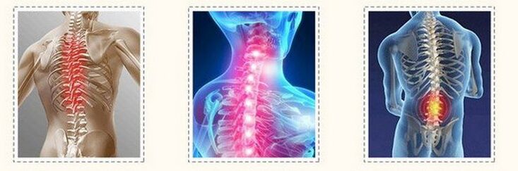 osteocondrosis de las diferentes columnas