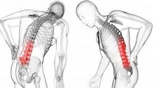 Hernia intervertebral complicación con osteocondosis