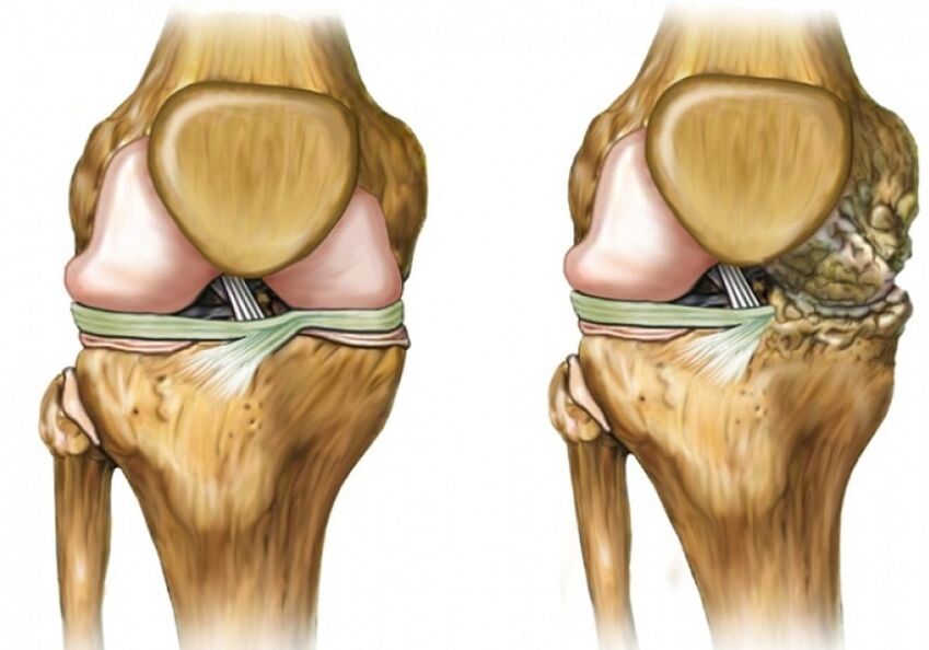 Osteoartritis de la rodilla