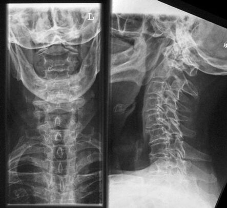 Cervical x -ray - método de diagnóstico de osteocondosis