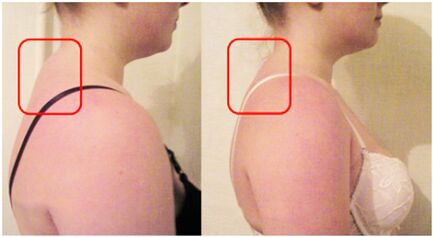 Formación de rodillos musculares con osteocondosis cervical
