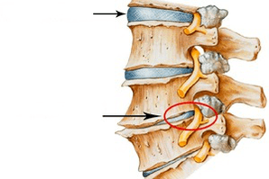 Columna vertebral normal y dañada con osteocondosis cervical.