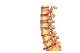 Daño espinal con osteocondosis cervical.