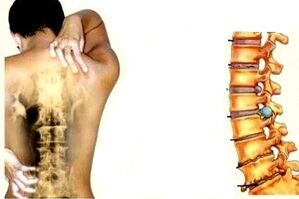 Dolor de espalda en diferentes etapas del desarrollo de la osteocondosis cervical