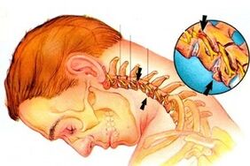 Nervo empedrando en la columna con osteocondosis cervical