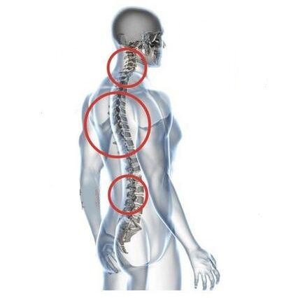 sitios de osteocondrosis espinal