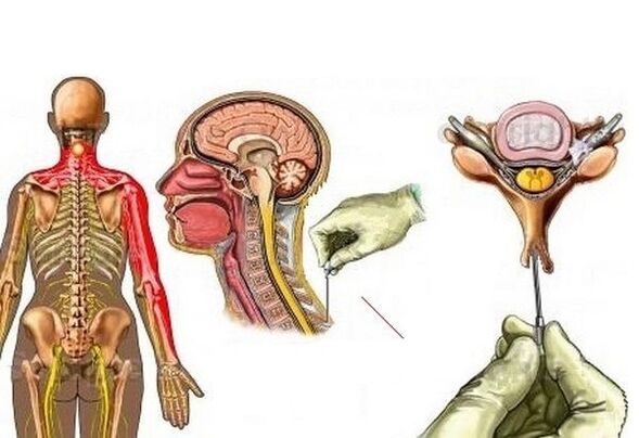 tratamiento de la osteocondrosis cervical con acupuntura