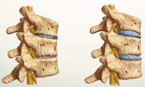 ¿Cómo se ve la osteocondrosis
