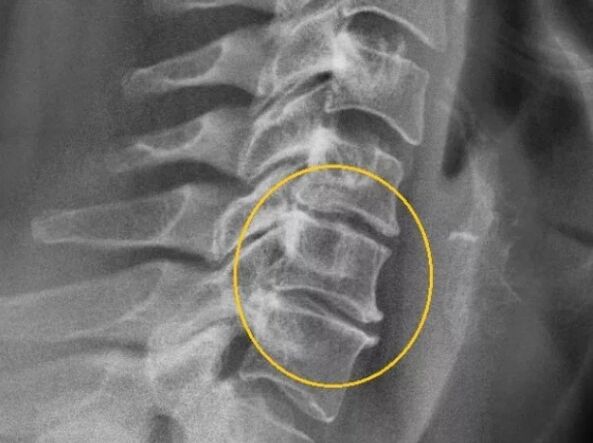 Osteocondrosis de la columna cervical en radiografía.
